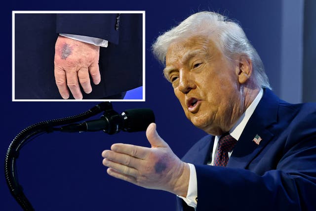 <p>Donald Trump was seen with extensive bruising on his hand at Davos, which he says was caused by “the big Aspirin”</p>